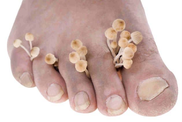 hongos en los pies