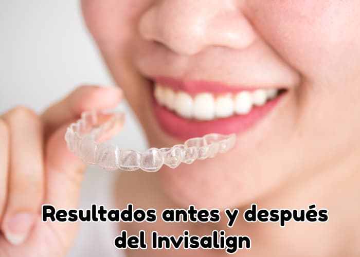 Resultados antes y después del Invisalign 