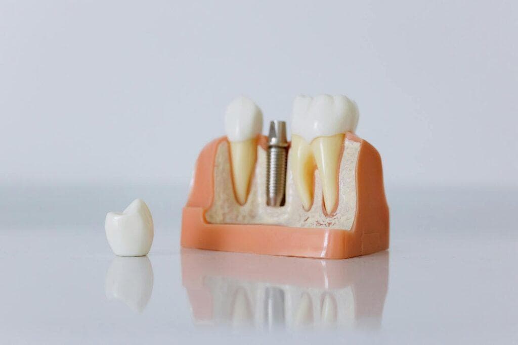 diferentes implantes dentales
