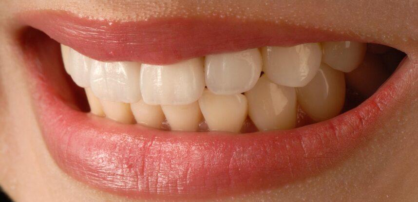 Carillas dentales: qué son y cuándo se recomiendan