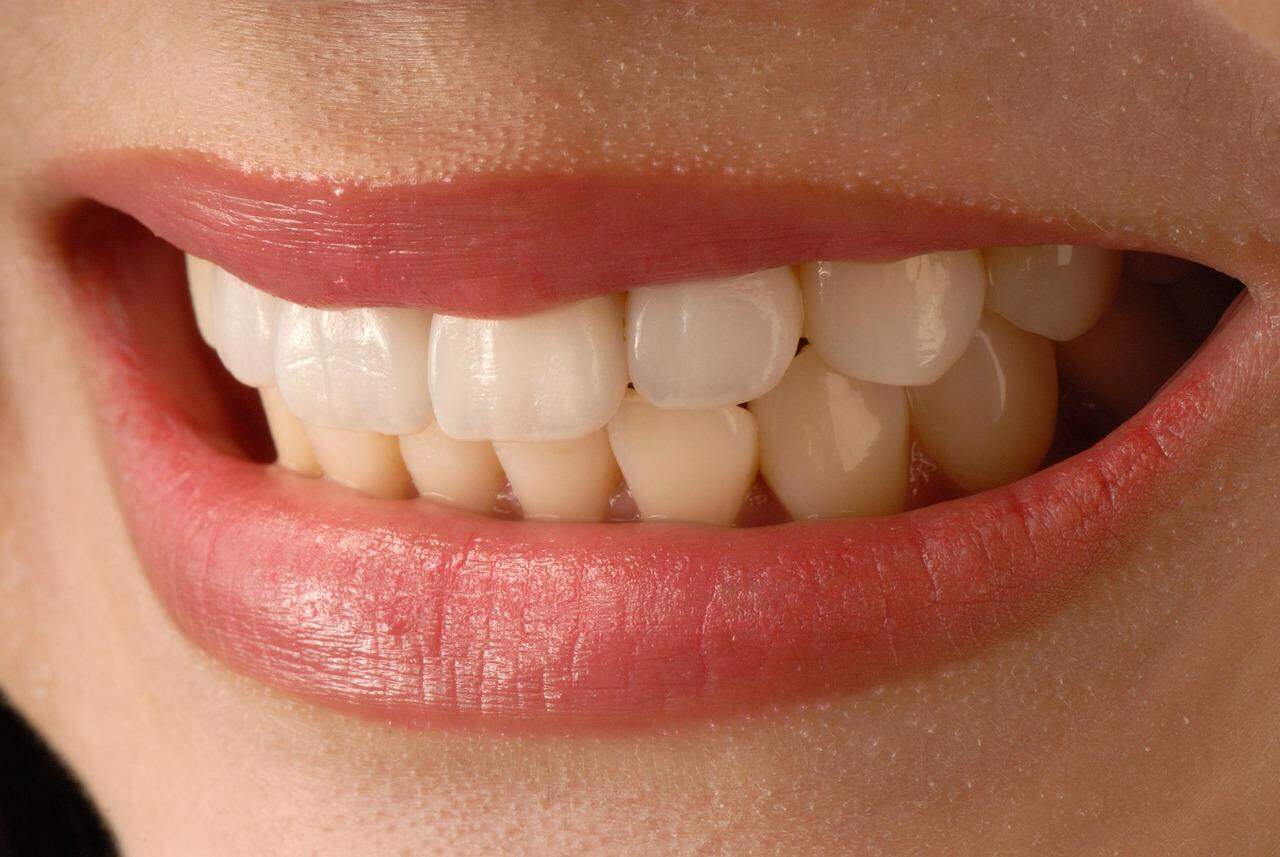 Carillas dentales: qué son y cuándo se recomiendan