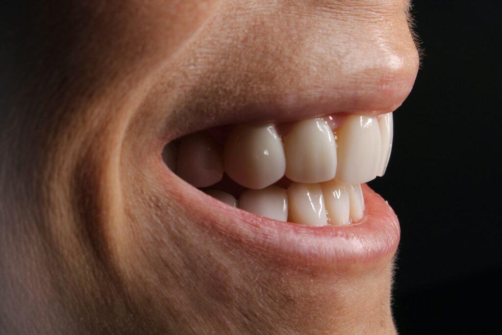 Carillas dentales: qué son